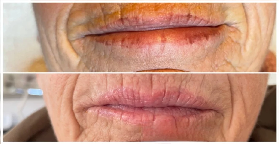 contour des levres Enlèvement d'un contour de lèvres après 2 traitements, photo réalisée 5 semaines après