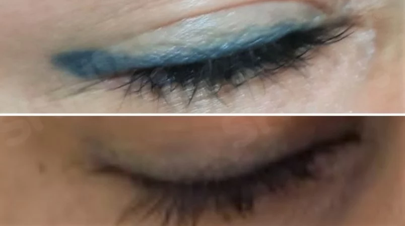 eye-liner 1 semaine Résultat d'enlèvement après 1 traitement