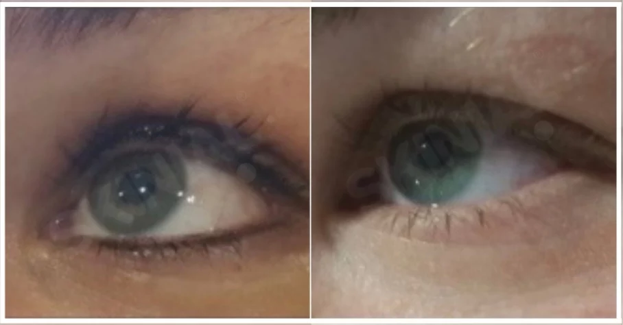 eye-liner 4 semaines Résultat d'enlèvement eye-liner après 4 traitements