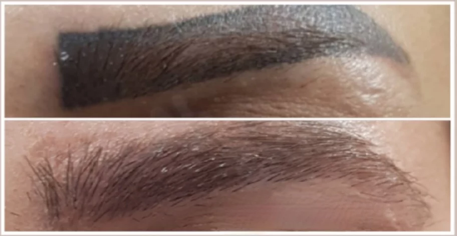 sourcils 1 Enlèvement d'un tatouage sourcils dont la forme était inesthétique. Résultat après 2 traitements